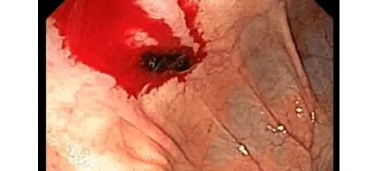 Endoscopia Gastrointestinal Leon Gto